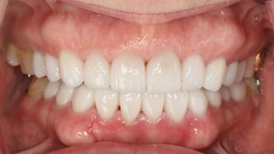 After cosmetic dental work completed by Irvine dentist Dr. Rice