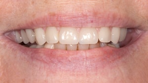 Kay-Hendricks-post-op-close-smile-min A patient's smile after All-On-4® Implant Dentures