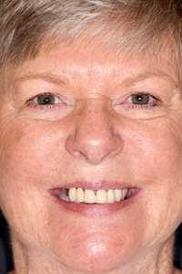 Kay-Hendricks-pre-op-face-min Pre-op smile of a dental patient of Dr. Rice before treatment was completed for her All-On-4® Implant Dentures