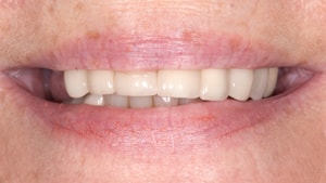 Pre-op smile of a patient looking to improve her smile with the help of Irvine dentist Dr. Rice