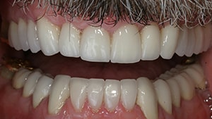 After smile of a patient who sought out dental treatment from Irvine cosmetic dentist Dr. Rice