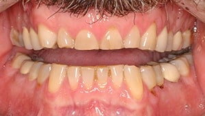 A before smile of a patient who sought treatment from a Irvine dentist for a smile makeover