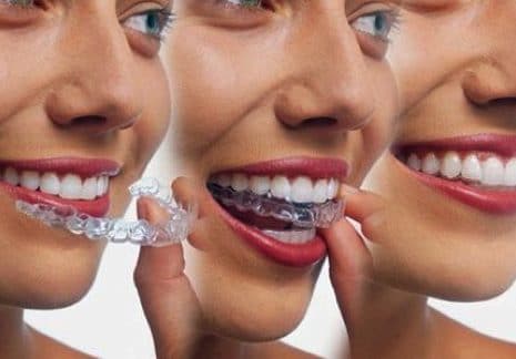 A transition of a patient with Invisalign clear braces on a woman