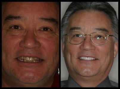 Rice Dentistry patient before and after porcelain veneers