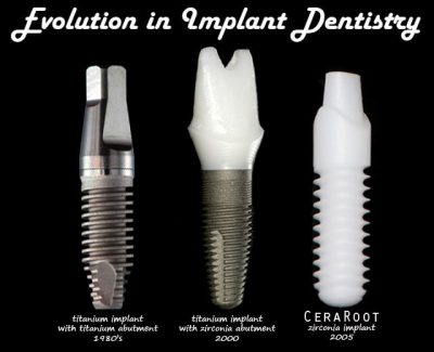 ceraroot dental implant evolution
