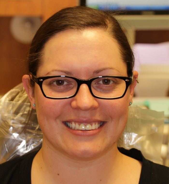 Sarah smile gallery page featured patient before photo