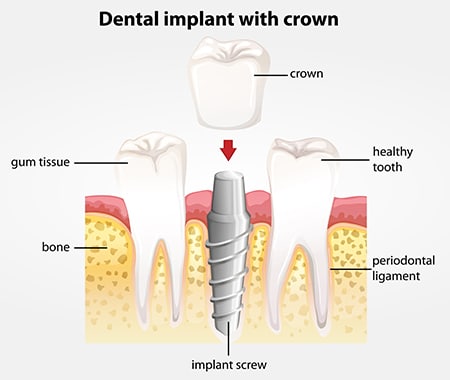 Ilustration of the dental implant and the crown