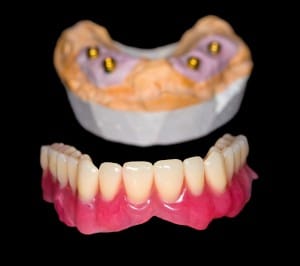  closeup of Implant Dentures